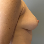 Breast Reconstruction Before & After Patient #8785