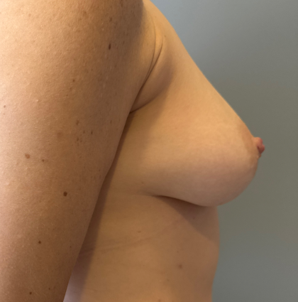 Breast Reconstruction Before & After Patient #8785