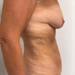 Breast Augmentation Before & After Patient #8792