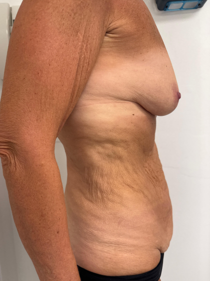 Breast Augmentation Before & After Patient #8792