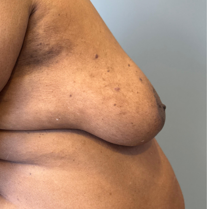 Breast Reconstruction Before & After Patient #8778