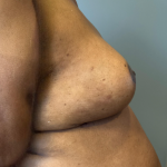 Breast Reconstruction Before & After Patient #8778
