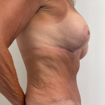 Breast Augmentation Before & After Patient #8792