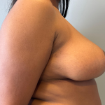 Breast Reduction Before & After Patient #8813