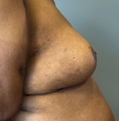 Breast Reconstruction Before & After Patient #8778