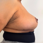 Breast Reduction Before & After Patient #8799