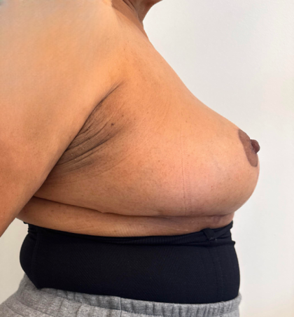 Breast Reduction Before & After Patient #8799