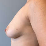 Breast Reconstruction Before & After Patient #8785