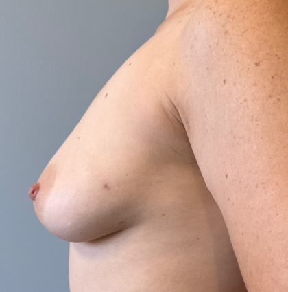 Breast Reconstruction Before & After Patient #8785