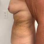 Breast Augmentation Before & After Patient #8792