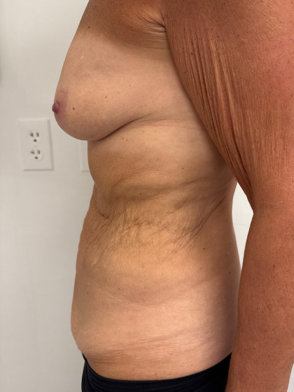 Breast Augmentation Before & After Patient #8792