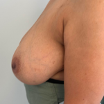 Breast Reduction Before & After Patient #8799