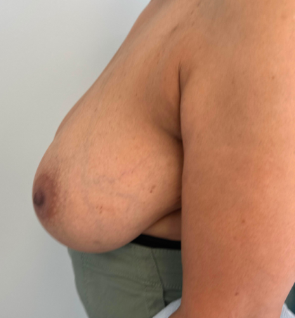 Breast Reduction Before & After Patient #8799