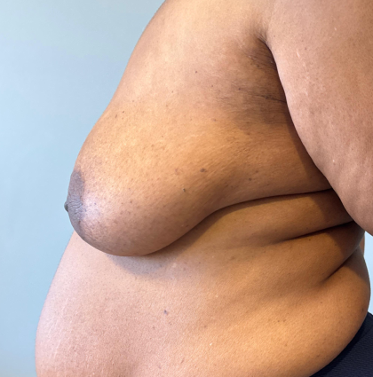 Breast Reconstruction Before & After Patient #8778