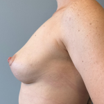 Breast Reconstruction Before & After Patient #8785