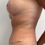 Breast Augmentation Before & After Patient #8792