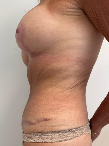 Breast Augmentation Before & After Patient #8792