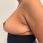 Breast Reduction Before & After Patient #8799