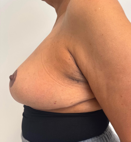 Breast Reduction Before & After Patient #8799