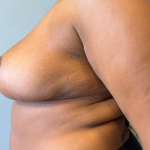 Breast Reduction Before & After Patient #8813