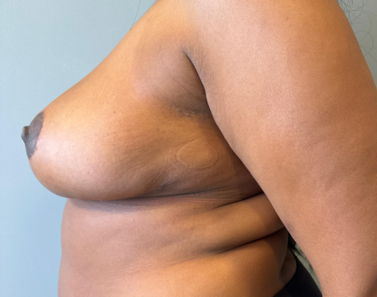 Breast Reduction Before & After Patient #8813