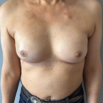 Breast Reconstruction Before & After Patient #8857