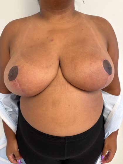 Breast Reduction Before & After Patient #8850