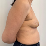 Breast Reconstruction Before & After Patient #8857