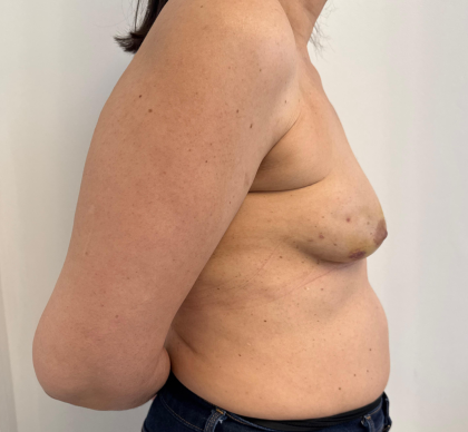 Breast Reconstruction Before & After Patient #8857