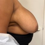 Breast Reduction Before & After Patient #8850