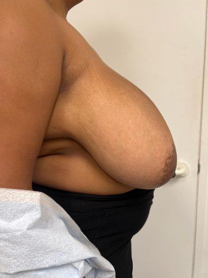 Breast Reduction Before & After Patient #8850
