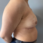 Breast Reconstruction Before & After Patient #8857