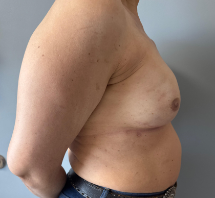 Breast Reconstruction Before & After Patient #8857