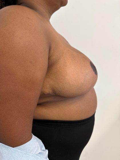Breast Reduction Before & After Patient #8850