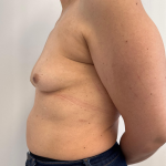 Breast Reconstruction Before & After Patient #8857