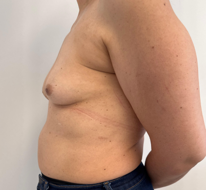 Breast Reconstruction Before & After Patient #8857