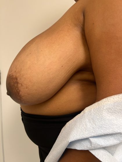 Breast Reduction Before & After Patient #8850