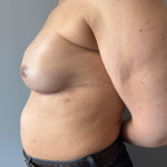 Breast Reconstruction Before & After Patient #8857