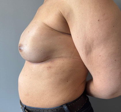 Breast Reconstruction Before & After Patient #8857