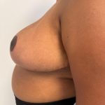 Breast Reduction Before & After Patient #8850