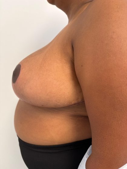 Breast Reduction Before & After Patient #8850