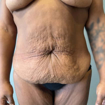 Post Bariatric Body Contouring Before & After Patient #8925