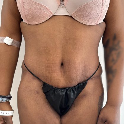 Post Bariatric Body Contouring Before & After Patient #8925