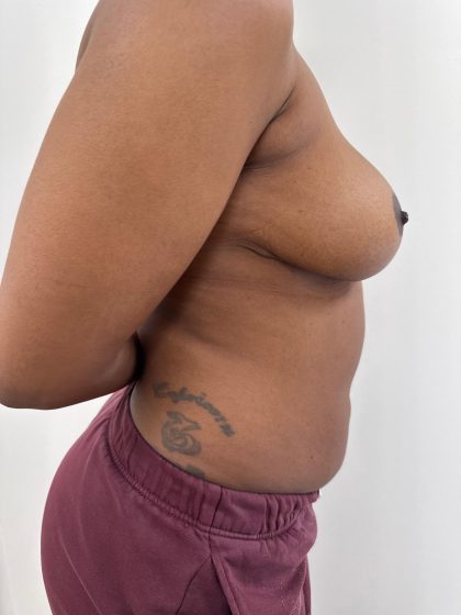 Breast Reduction Before & After Patient #8918