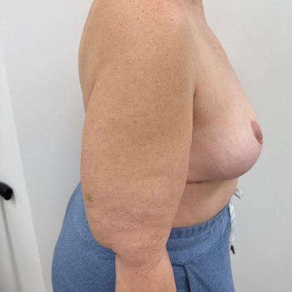 Breast Reconstruction Before & After Patient #8946