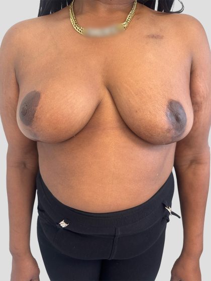 Oncoplastic Breast Reconstruction Before & After Patient #8957
