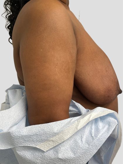 Oncoplastic Breast Reconstruction Before & After Patient #8957