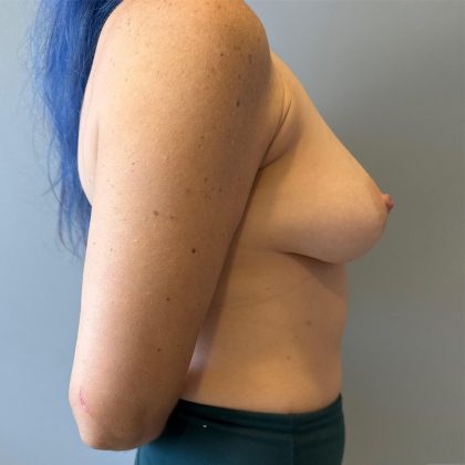 Oncoplastic Breast Reconstruction Before & After Patient #8958