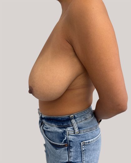 Breast Reduction Before & After Patient #8971