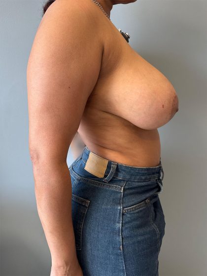 Breast Reduction Before & After Patient #8938
